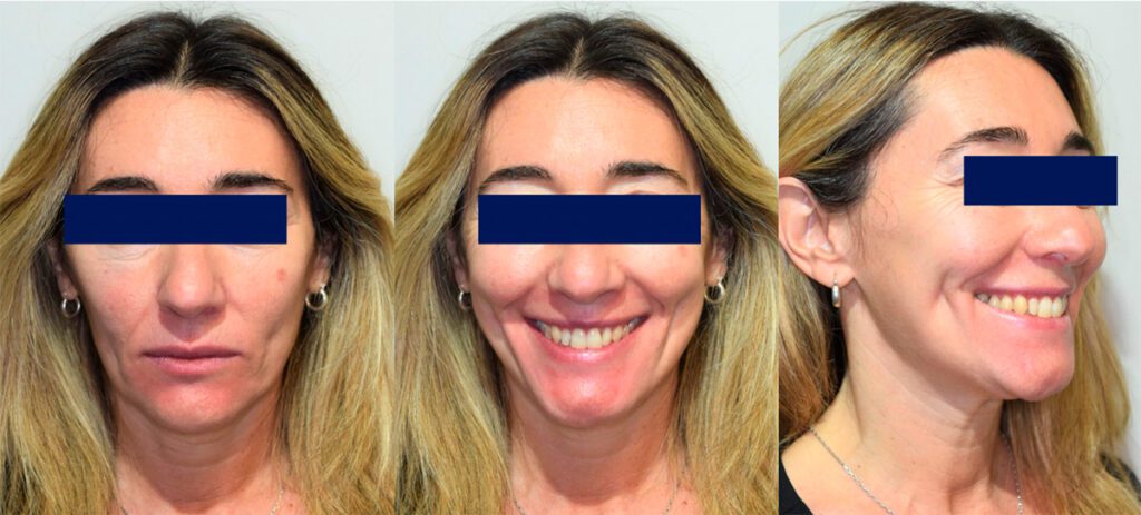 Recuperando la estética y función en paciente adulto: resultado final (2)
